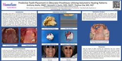 Thumbnail for Predictive Tooth Placement in Obturator Prostheses Utilizing Volumetric Healing Patterns