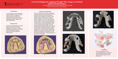 Preview of A Novel Technique for Applying Wrought Wire Clasps to a Printed Interim Partial Denture
