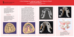 Thumbnail for A Novel Technique for Applying Wrought Wire Clasps to a Printed Interim Partial Denture