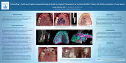 Thumbnail for Fabricating a tooth and implant-supported surgical guide for implant placement in a terminal dentition patient with existing implants.