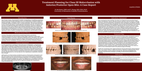 Preview of Treatment Planning for Class III Malocclusion with Anterior/Posterior Open Bite: A Case Report