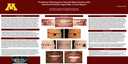 Thumbnail for Treatment Planning for Class III Malocclusion with Anterior/Posterior Open Bite: A Case Report
