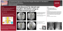 Thumbnail for AN EXTRAFORAMINAL APPROACH TO DORSAL ROOT GANGLION STIMULATION IN A SACRALIZED L5