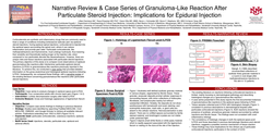 Thumbnail for NARRATIVE REVIEW & CASE SERIES OF GRANULOMA-LIKE REACTION AFTER PARTICULATE STEROID INJECTION: IMPLICATIONS FOR EPIDURAL INJECTION
