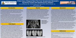 Thumbnail for A RARE CASE OF ATYPICAL BACK PAIN FROM SYMPTOMATIC BERTOLOTTI’S SYNDROME TREATED WITH RADIOFREQUENCY ABLATION