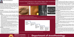 Thumbnail for CRESCENT FLUID COLLECTION IN THE LUMBAR REGION AFTER INTRATHECAL DRUG DELIVERY SYSTEM IMPLANTATION