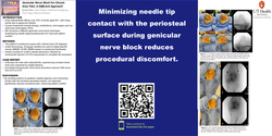 Thumbnail for GENICULAR NERVE BLOCK FOR CHRONIC KNEE PAIN: A DIFFERENT APPROACH