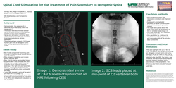 Thumbnail for SPINAL CORD STIMULATION FOR THE TREATMENT OF PAIN SECONDARY TO IATROGENIC SYRINX