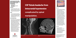 Thumbnail for CEREBROSPINAL FLUID (CSF) FISTULA HEADACHE FOLLOWING THORACOLUMBAR SPINAL MANIPULATION