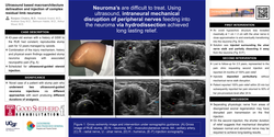 Thumbnail for ULTRASOUND BASED MACROARCHITECTURE DELINEATION AND INJECTION OF COMPLEX RESIDUAL LIMB NEUROMA