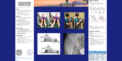 Thumbnail for FEMOROACETABULAR IMPINGEMENT: A REAL PAIN IN THE BACK