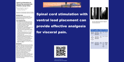 Thumbnail for SPINAL CORD STIMULATION FOR VISCERAL PAIN ASSOCIATED WITH MEDULLARY SPONGE KIDNEY