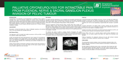 Thumbnail for CASE REPORT: PALLIATIVE CRYONEUROLYSIS FOR INTRACTABLE PAIN FROM PUDENDAL NERVE & SACRAL GANGLION PLEXUS INVASION OF PELVIC TUMOUR