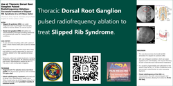 Thumbnail for SUCCESSFUL USE OF THORACIC DORSAL ROOT GANGLION PULSED RADIOFREQUENCY ABLATION TO TREAT SLIPPED RIB SYNDROME IN A NAVY SAILOR