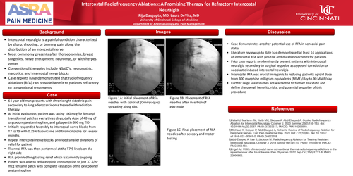 Preview of INTERCOSTAL RADIOFREQUENCY ABLATIONS: A PROMISING THERAPY FOR REFRACTORY INTERCOSTAL NEURALGIA