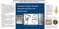 Thumbnail for DORSAL ROOT GANGLION (DRG) STIMULATOR FOR THE TREATMENT OF SINUS TARSI SYNDROME.