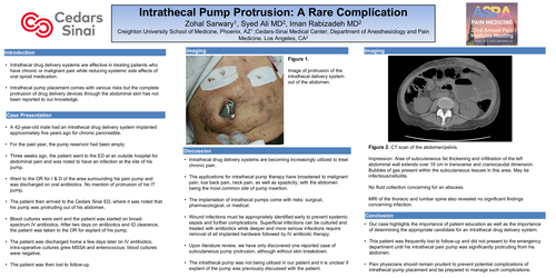 Preview of INTRATHECAL PUMP PROTRUSION: A RARE COMPLICATION