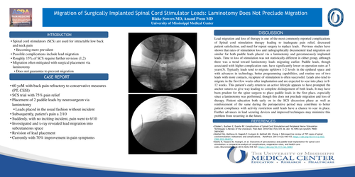Preview of MIGRATION OF SURGICALLY IMPLANTED SPINAL CORD STIMULATOR LEADS: LAMINOTOMY DOES NOT PRECLUDE MIGRATION.