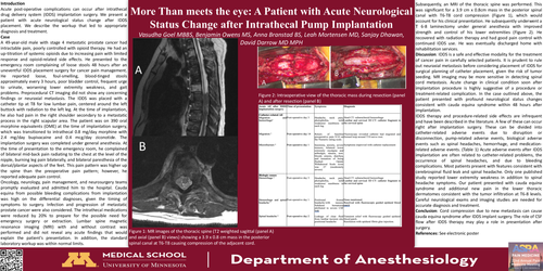 Preview of MORE THAN MEETS THE EYE: A PATIENT WITH ACUTE NEUROLOGICAL STATUS CHANGE AFTER INTRATHECAL PUMP IMPLANTATION