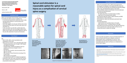 Thumbnail for POST CERVICAL LAMINECTOMY NEUROPATHIC PAIN, DECREASED PROPRIOCEPTION AND ALLODYNIA RESOLUTION WITH SPINAL CORD STIMULATOR