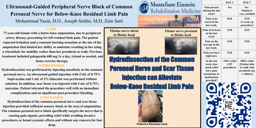 Preview of ULTRASOUND-GUIDED PERIPHERAL NERVE BLOCK OF COMMON PERONEAL NERVE FOR BELOW-KNEE RESIDUAL LIMB PAIN