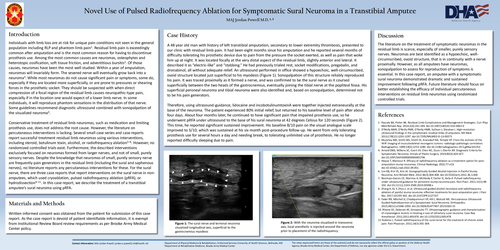 Preview of NOVEL USE OF PULSED RADIOFREQUENCY ABLATION FOR SYMPTOMATIC SURAL NEUROMA IN A TRANSTIBIAL AMPUTEE