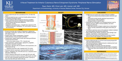 Preview of A NOVEL TREATMENT FOR ANTERIOR CUTANEOUS NERVE ENTRAPMENT SYNDROME: PERIPHERAL NERVE STIMULATION