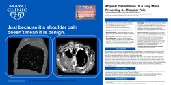 Thumbnail for ATYPICAL PRESENTATION OF A LUNG MASS DISGUISED AS SHOULDER PAIN
