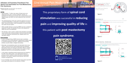 Thumbnail for UTILIZATION OF PROPRIETARY PARESTHESIA FREE SPINAL CORD STIMULATION FOR POST-MASTECTOMY PAIN SYNDROME