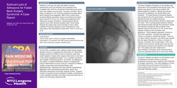 Thumbnail for SUCCESSFUL EPIDURAL-LYSIS OF ADHESIONS FOR FAILED BACK SURGERY SYNDROME: A CASE REPORT