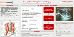 Thumbnail for PSOAS SYNDROME AFTER HIP REPLACEMENT SURGERY