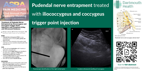 Preview of TREATMENT OF PUDENDAL NERVE ENTRAPMENT BY ILIOCOCCYGEUS TRIGGER POINT INJECTIONS WITH COMBINED X-RAY AND ULTRASOUND GUIDANCE