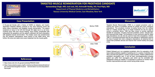 Preview of TARGETED MUSCLE REINNERVATION FOR PROSTHESIS CANDIDATE