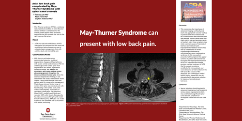 Preview of AXIAL LOW BACK PAIN COMPLICATED BY MAY-THURNER SYNDROME WITH SPINAL CANAL STENOSIS: A CASE REPORT