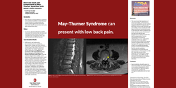 Thumbnail for AXIAL LOW BACK PAIN COMPLICATED BY MAY-THURNER SYNDROME WITH SPINAL CANAL STENOSIS: A CASE REPORT