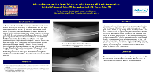 Preview of BILATERAL POSTERIOR SHOULDER DISLOCATION WITH REVERSE HILL-SACHS DEFORMITIES