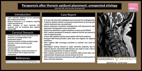 Preview of PARAPARESIS AFTER THORACIC EPIDURAL PLACEMENT: UNEXPECTED ETIOLOGY