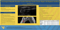 Thumbnail for A CASE OF POST-SURGICAL IDIOPATHIC BRACHIAL NEURITIS FOLLOWING CLAVICLE FRACTURE REPAIR WITH REGIONAL ANESTHESIA