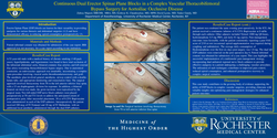 Thumbnail for CONTINUOUS DUAL ERECTOR SPINAE PLANE BLOCKS IN A COMPLEX VASCULAR THORACOBIFEMORAL BYPASS SURGERY FOR AORTOILIAC OCCLUSIVE DISEASE