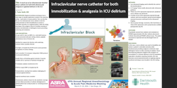 Thumbnail for A NOVEL USE OF AN INFRACLAVICULAR BRACHIAL PLEXUS CATHETER FOR BOTH LIMB AKINESIA AND ANALGESIA IN AGITATED DELIRIUM IN THE ICU