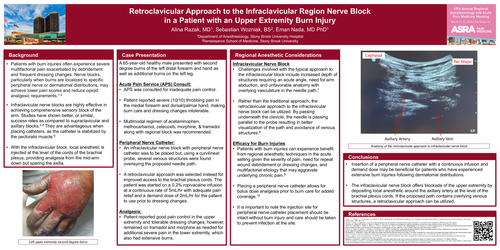 Preview of RETROCLAVICULAR APPROACH TO THE INFRACLAVICULAR REGION NERVE BLOCK IN A PATIENT WITH AN UPPER EXTREMITY BURN INJURY