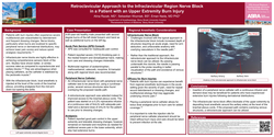 Thumbnail for RETROCLAVICULAR APPROACH TO THE INFRACLAVICULAR REGION NERVE BLOCK IN A PATIENT WITH AN UPPER EXTREMITY BURN INJURY