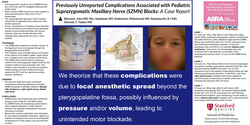 Thumbnail for PREVIOUSLY UNREPORTED COMPLICATIONS ASSOCIATED WITH PEDIATRIC SUPRAZYGOMATIC MAXILLARY NERVE (SZMN) BLOCKS: A CASE REPORT