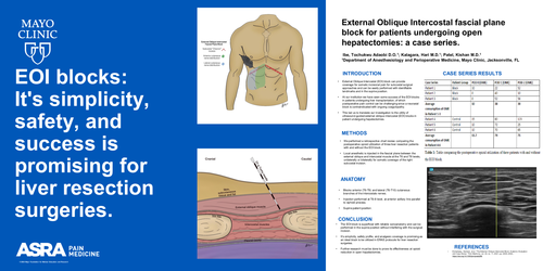 Preview of EXTERNAL OBLIQUE INTERCOSTAL FASCIAL PLANE BLOCK FOR PATIENTS UNDERGOING OPEN HEPATECTOMY SURGERIES: A CASE SERIES.