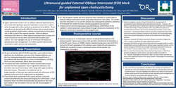 Thumbnail for ULTRASOUND GUIDED EXTERNAL OBLIQUE INTERCOSTAL (EOI) BLOCK FOR UNPLANNED OPEN CHOLECYSTECTOMY.