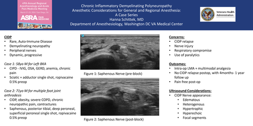 Preview of CHRONIC INFLAMMATORY DEMYELINATING POLYNEUROPATHY, ANESTHETIC CONSIDERATIONS FOR GENERAL AND REGIONAL ANESTHESIA: A CASE SERIES