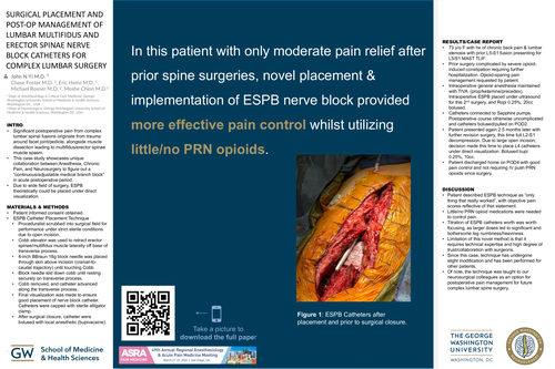 Preview of SURGICAL PLACEMENT AND POST-OP MANAGEMENT OF LUMBAR MULTIFIDUS AND ERECTOR SPINAE NERVE BLOCK CATHETERS FOR COMPLEX LUMBAR SURGERY