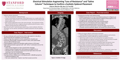 Thumbnail for ELECTRICAL STIMULATION AUGMENTING "LOSS OF RESISTANCE" AND "SALINE COLUMN" TECHNIQUES TO CONFIRM A SCOLIOTIC EPIDURAL PLACEMENT