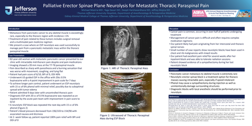 Preview of PALLIATIVE ERECTOR SPINAE PLANE NEUROLYSIS FOR METASTATIC THORACIC PARASPINAL PAIN