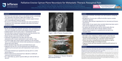 Thumbnail for PALLIATIVE ERECTOR SPINAE PLANE NEUROLYSIS FOR METASTATIC THORACIC PARASPINAL PAIN